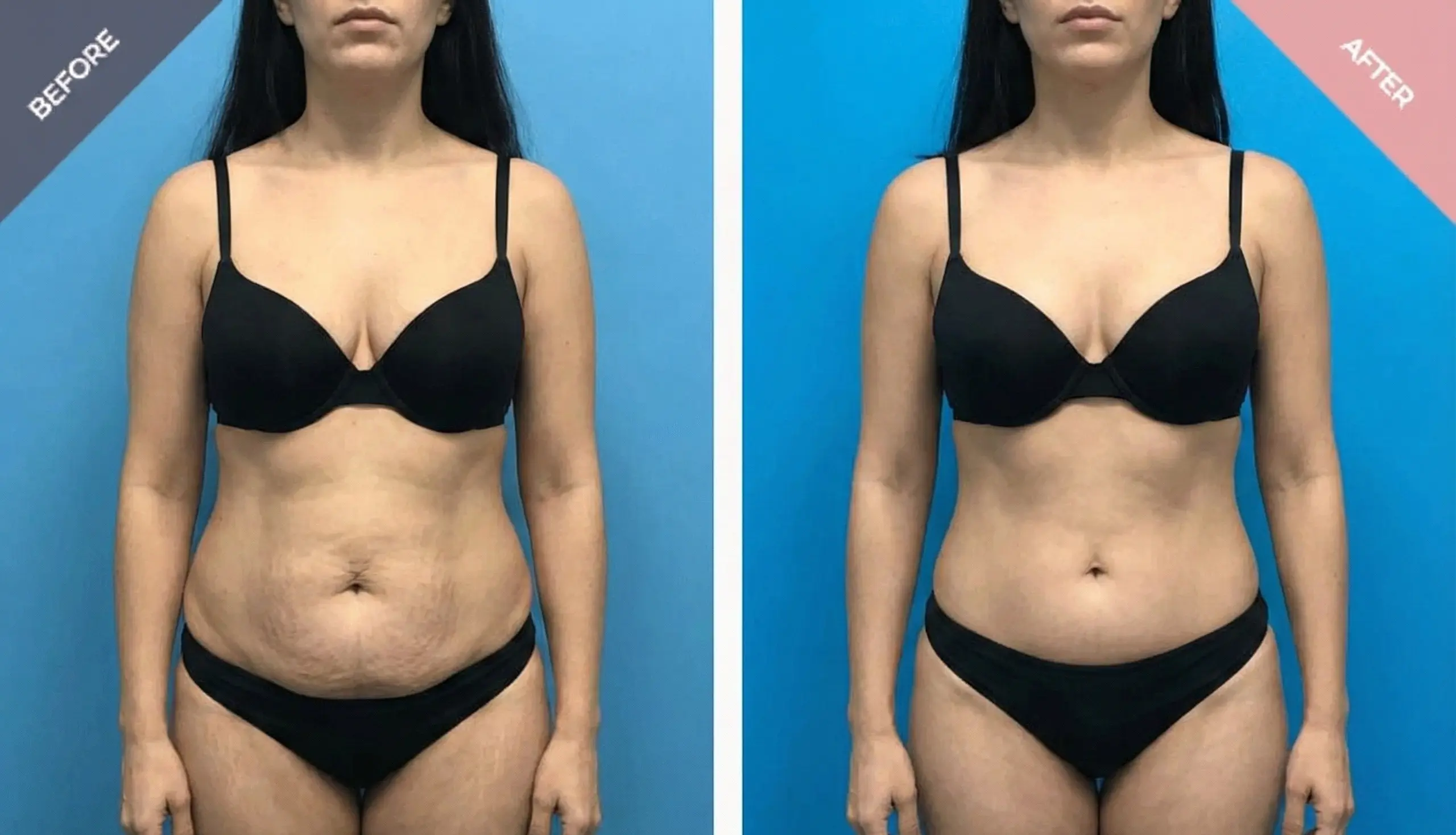 Reverse Tummy Tuck Reverse Abdominoplasty Upper Abdominal Skin reverse-tummy-tuck-reverse-abdominoplasty-upper-abdominal-skin